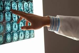 brain injury, San Jose personal injury attorney