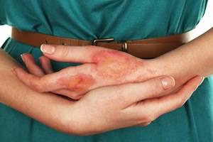 burn injuries, San Jose burn injury attorney